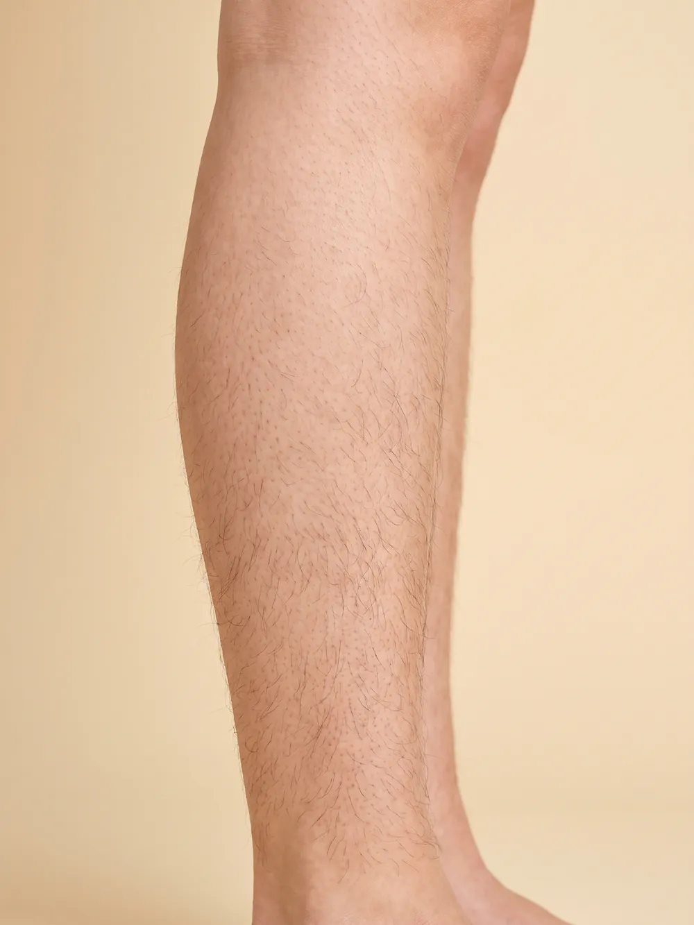 Before: GentleMax Pro Plus®